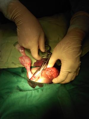 切除睾丸手术男人图片